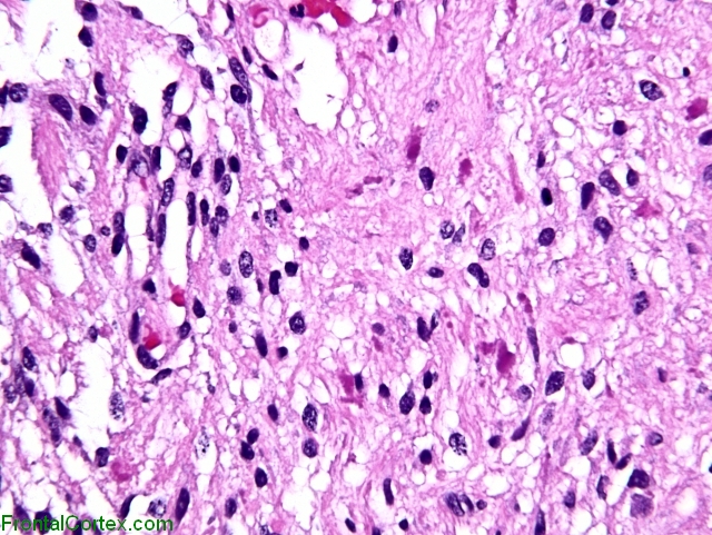 Pilocytic Astrocytoma x400